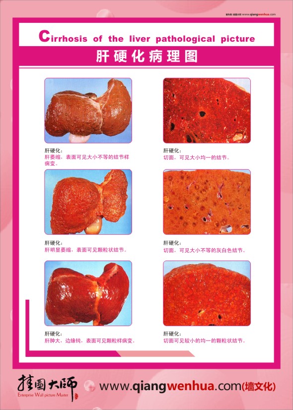 肝病健康教育 肝硬化病理圖片